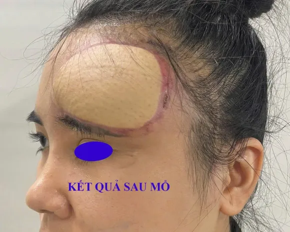 Ca Lâm Sàng: Chuyển Ngón Chân Tái Tạo Ngón Tay