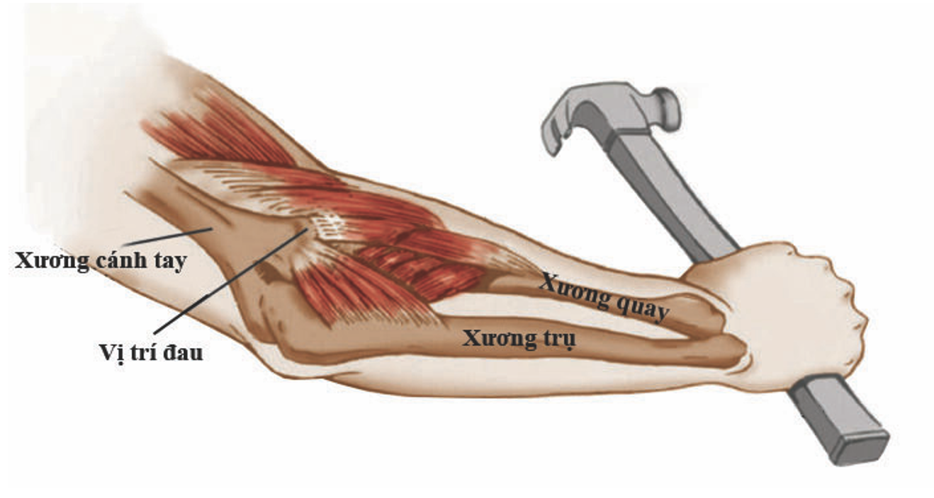 ĐAU KHUỶU TAY CỦA NGƯỜI CHƠI TENNIS TENNIS ELBOW