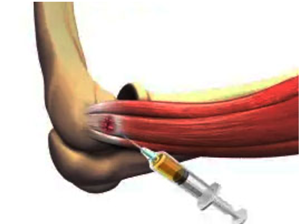 Hình 3. Chích PRP chứa tế bào gốc