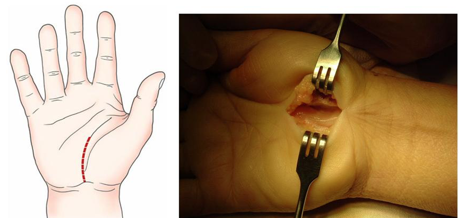 Đường mổ cắt d&acirc;y chằng ngang cổ ta giải &eacute;p thần kinh giữa