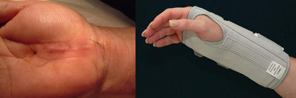 Kết quả sau mổ, bệnh nh&acirc;n được kh&acirc;u thẩm mỹ, v&agrave; mang nẹp cổ tay