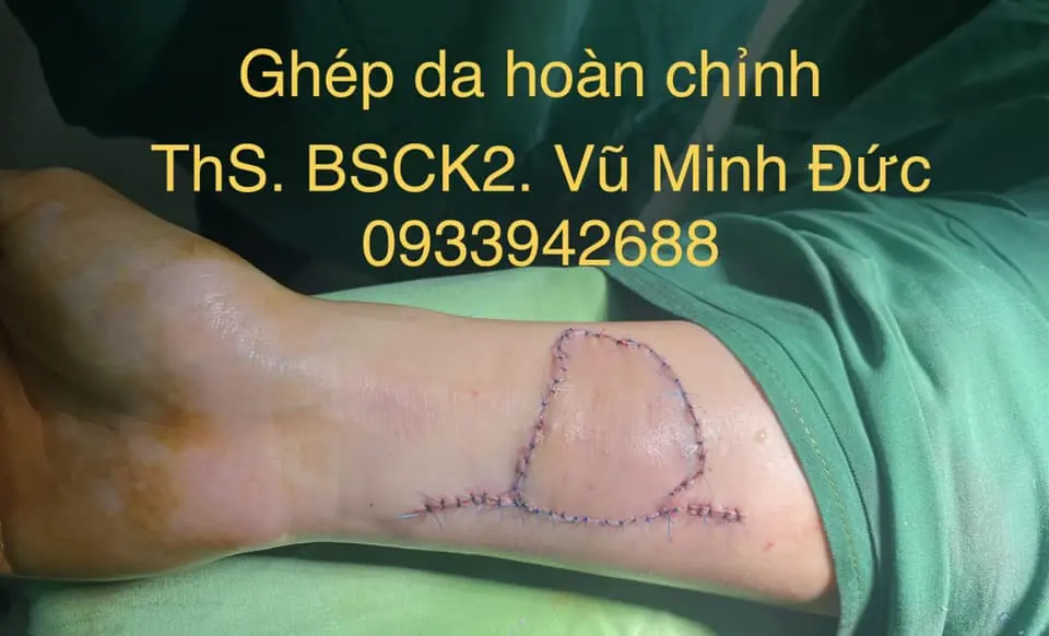 Kết quả ngay sau khi gh&eacute;p da
