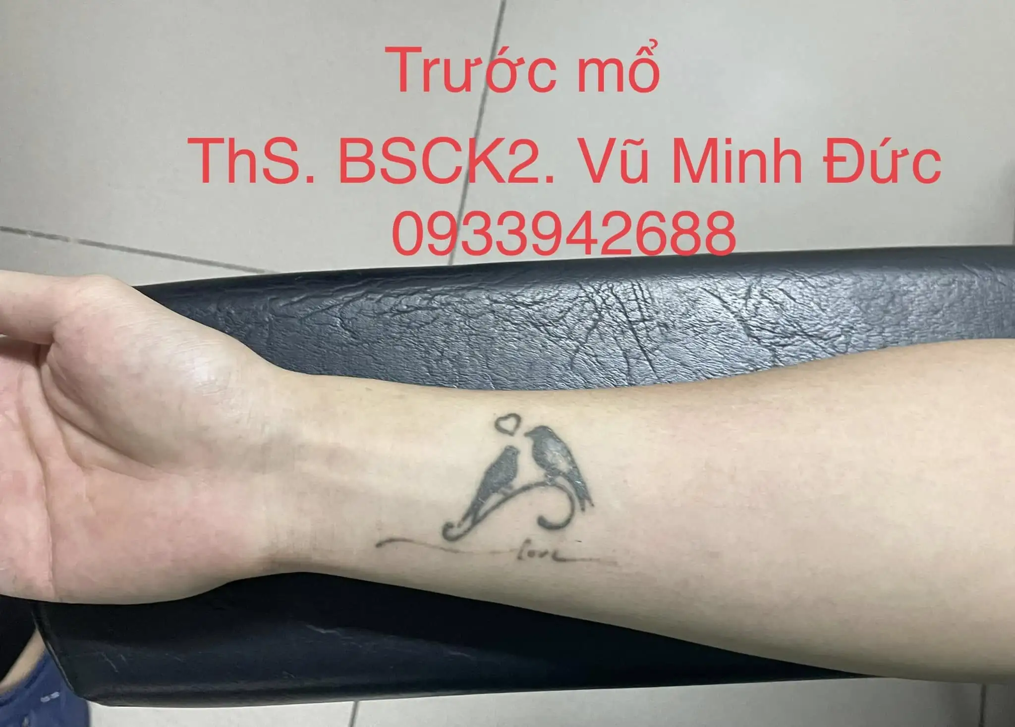 XÓA XĂM BẰNG PHẪU THUẬT GHÉP DA: GIẢI PHÁP 