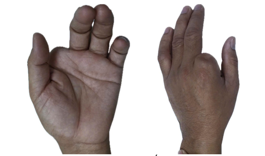 Hình ảnh mất ngón trỏ