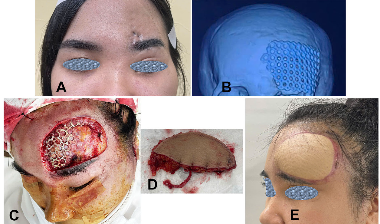 Vạt Đùi Trước Ngoài che phủ lộ nẹp vùng trán
