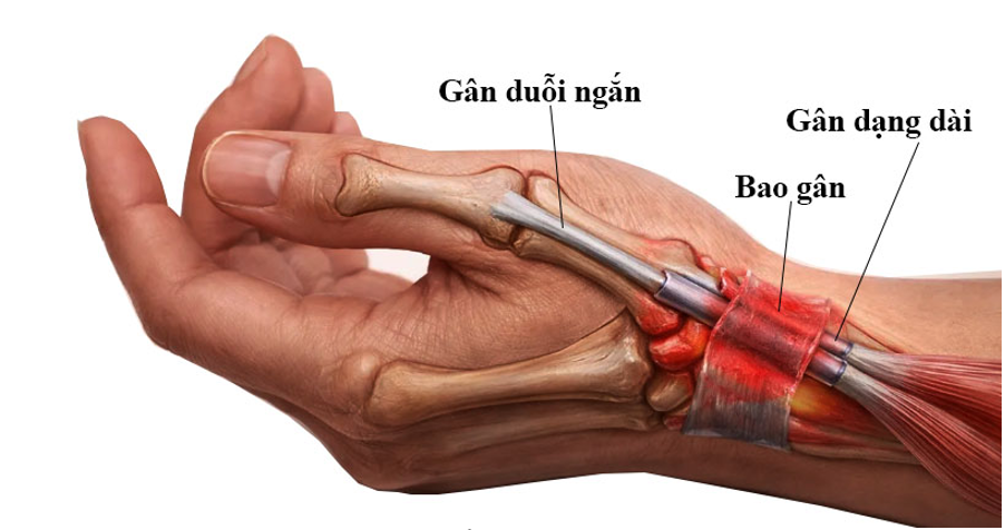 Vị trí đau ở cổ tay trong bệnh De Quervain