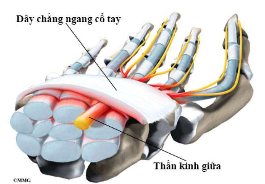 Dây thần kinh giữa bị dây chằng ngang đè ép trong hội chứng ống cổ tay