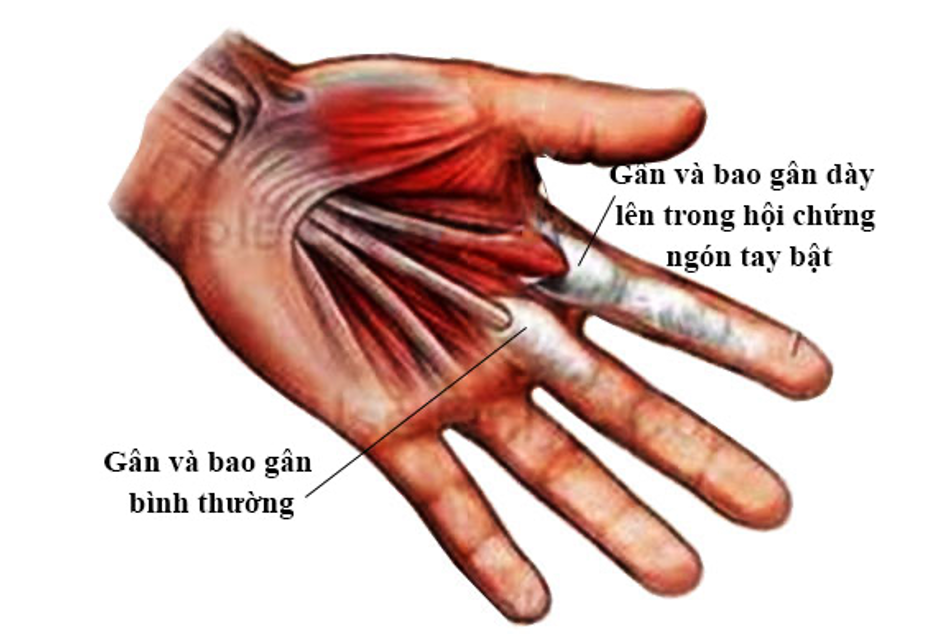 ình ản kẹt gân trong hội chứng ngón tay bật