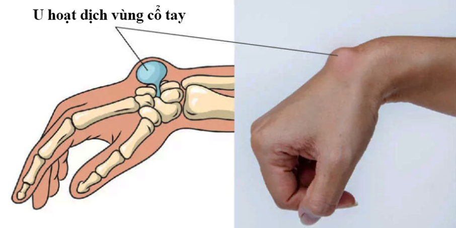 Hình ảnh u bao hoạt dịch vùng cổ tay