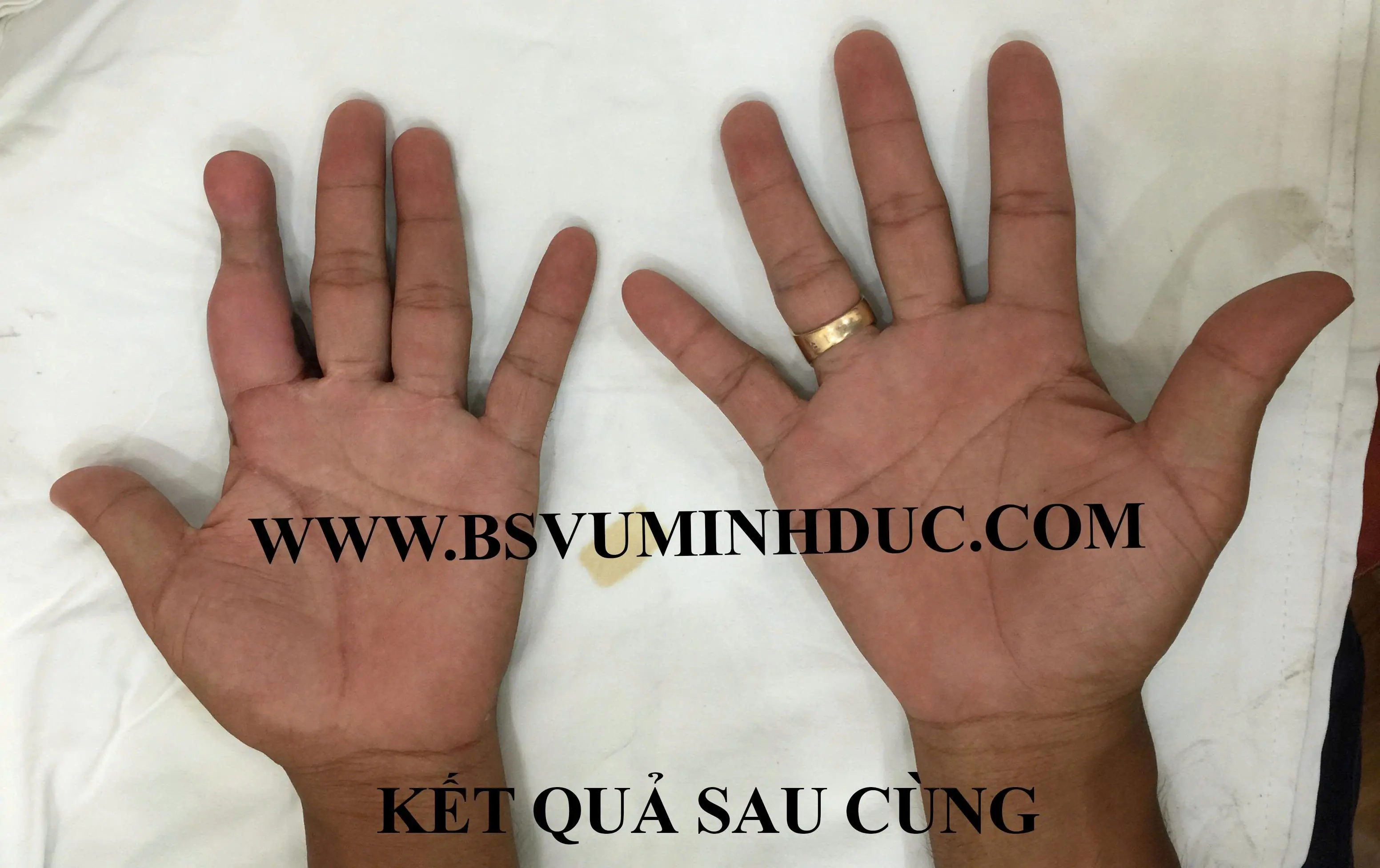 Ca Lâm Sàng: Chuyển Ngón Chân Tái Tạo Ngón Tay