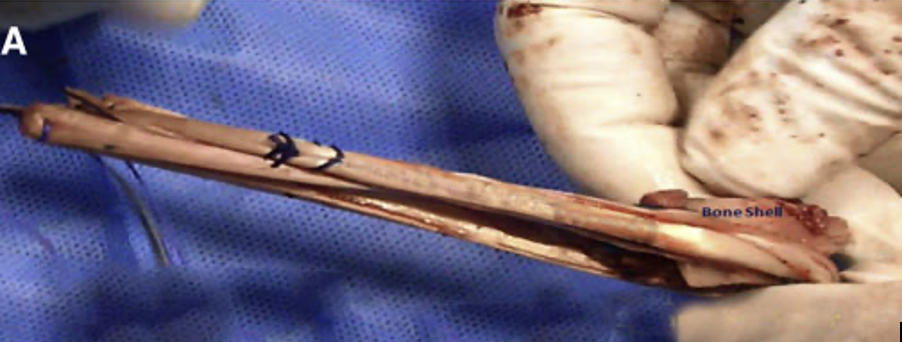 Mảnh gh&eacute;p Hamstring