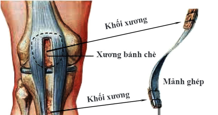 Mảnh gh&eacute;p g&acirc;n b&aacute;nh ch&egrave;