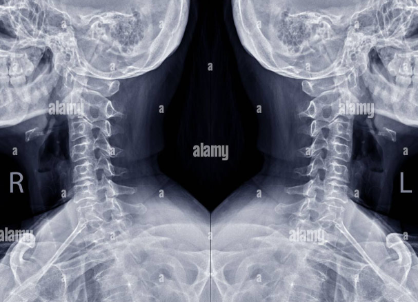 X- quang cột sống cổ chếch ¾