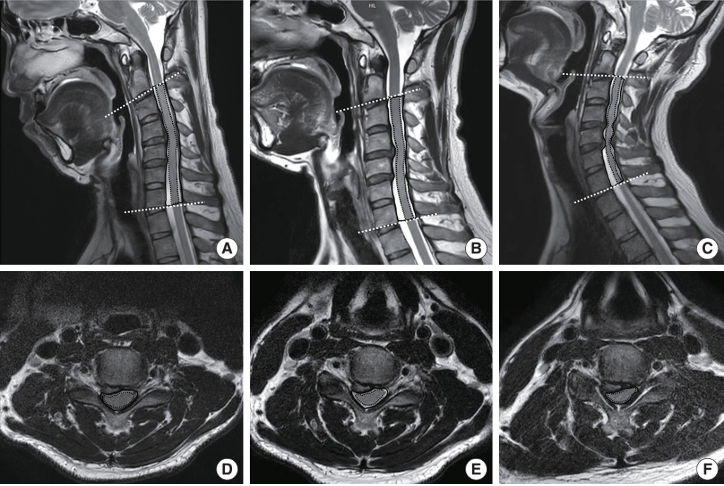 Hình ảnh MRI cột sống cổ