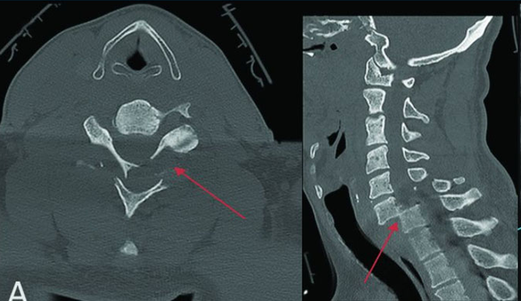 Hình ảnh CT scan cột sốt cổ