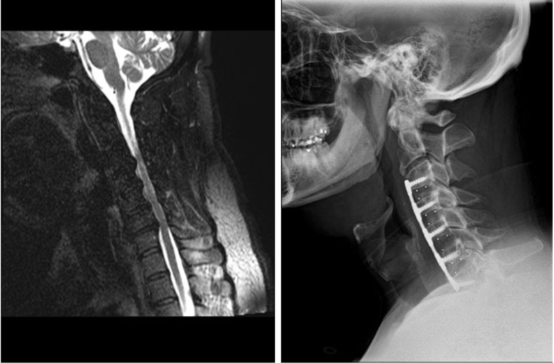 Hình ảnh thay đĩa đệm cột sống cổ hàn liên thân sống