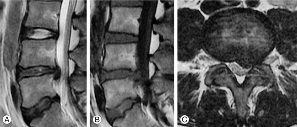 Hình ảnh MRI cho thấy thoát vị đĩa đệm tầng L4-L5