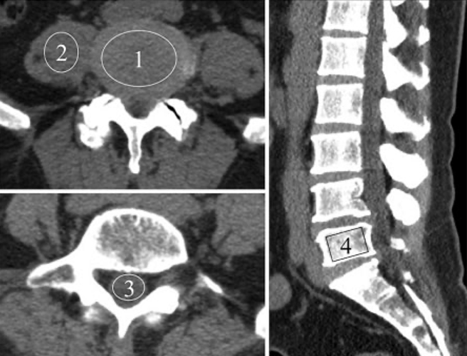 Hình ảnh CT-scan cột sống thắt lưng