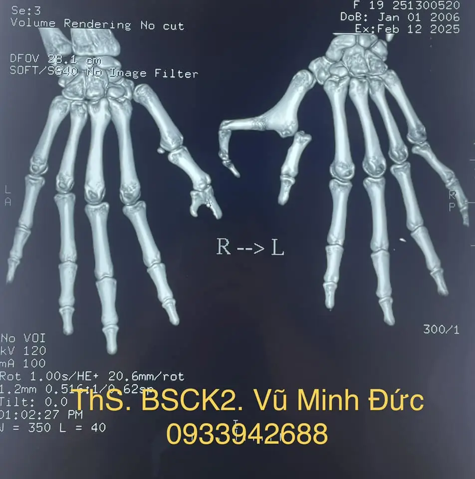 Bệnh Bàn Tay 