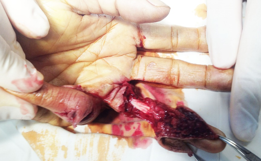 Tổn thương lột găng gần ho&agrave;n to&agrave;n ng&oacute;n 4 (Chụp mặt l&ograve;ng)