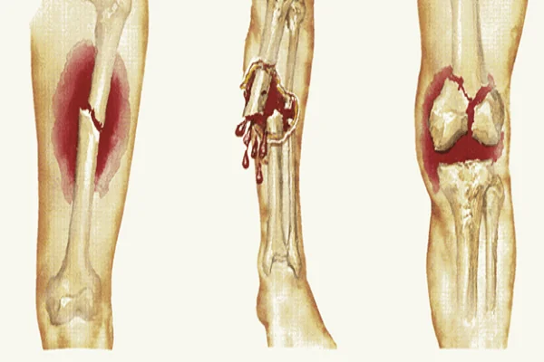 Gãy xương bao lâu thì lành? Thời gian hồi phục và những điều cần biết